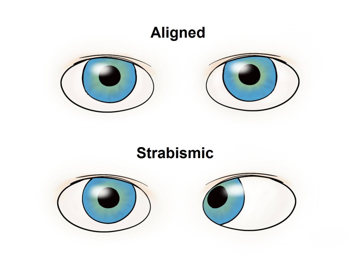 Strabismus Tracking